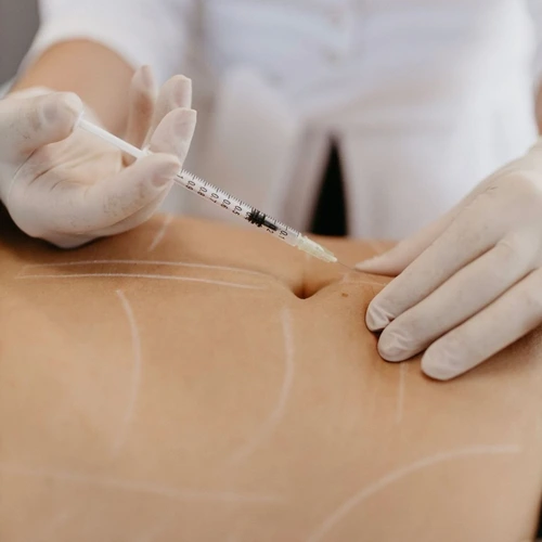 Medizinische Fettreduktion – Lipolyse